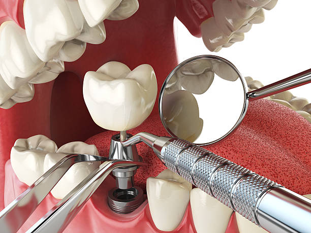 Best Emergency Treatment for Dental Infections or Abscesses in Westover, AL